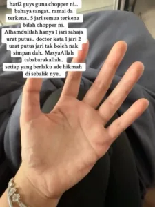 Bahaya Chopper Makan Tuan, Nak Betulkan Bilah Tercabut Wanita Putus 2 Urat Jari