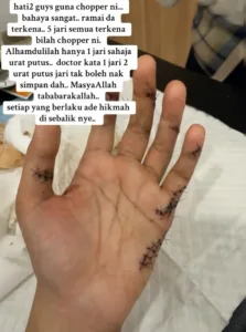 Bahaya Chopper Makan Tuan, Nak Betulkan Bilah Tercabut Wanita Putus 2 Urat Jari